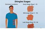 Shingles Stages