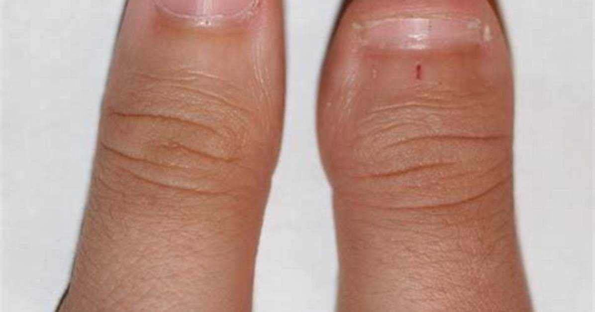 Short Thumbs