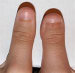 Short Thumbs