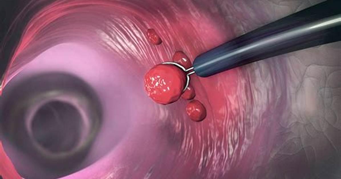 Should a Polyp Be Removed?