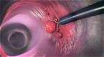 Should a Polyp Be Removed?