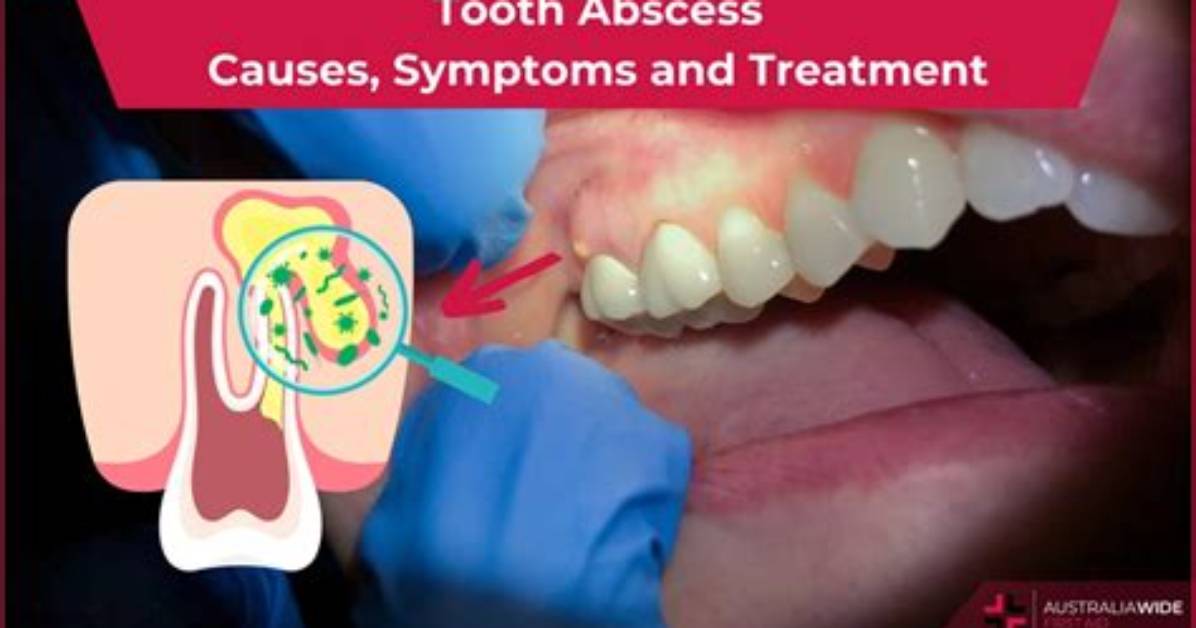 Should Abscessed Tooth Be Pulled?