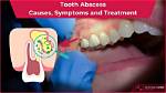 Should Abscessed Tooth Be Pulled?