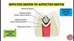 Should Affected Dentin Be Removed?