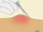 Should Boils Be Lanced?