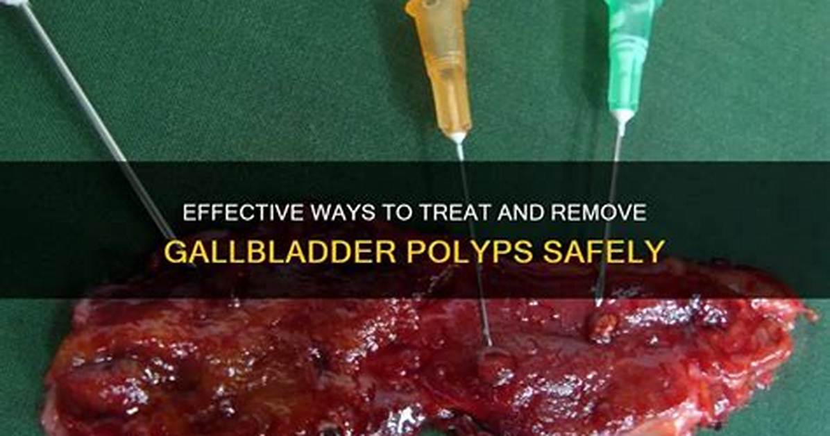 Should Gallbladder Polyps Be Removed?