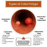 Should Hyperplastic Polyps Be Removed?