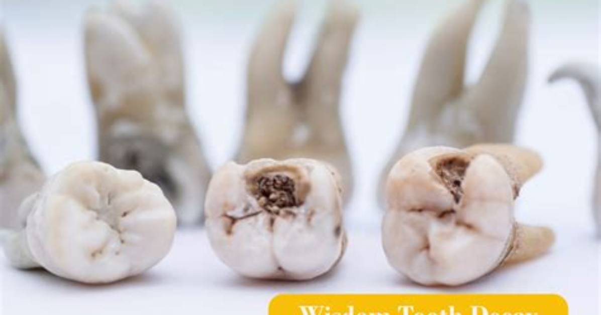 Should I Remove Decayed Wisdom Tooth?