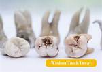 Should I Remove Decayed Wisdom Tooth?