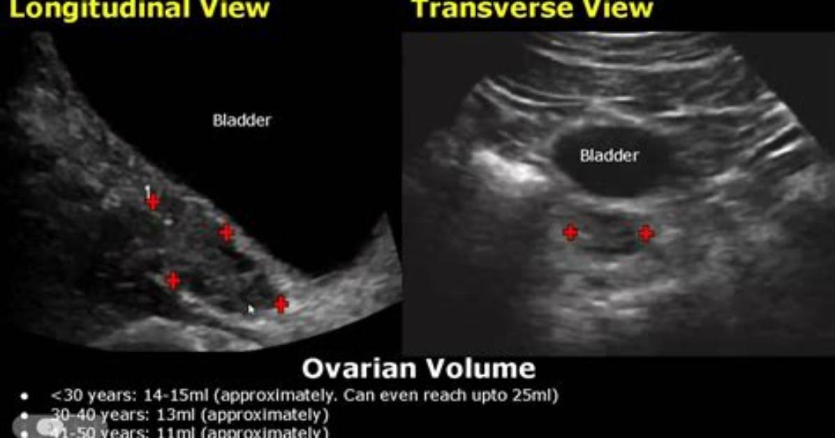 Should Ovary Volume Differ?