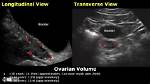 Should Ovary Volume Differ?