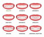 Should Teeth Wobble Slightly?