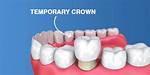 Should Temporary Crown Be Sensitive?