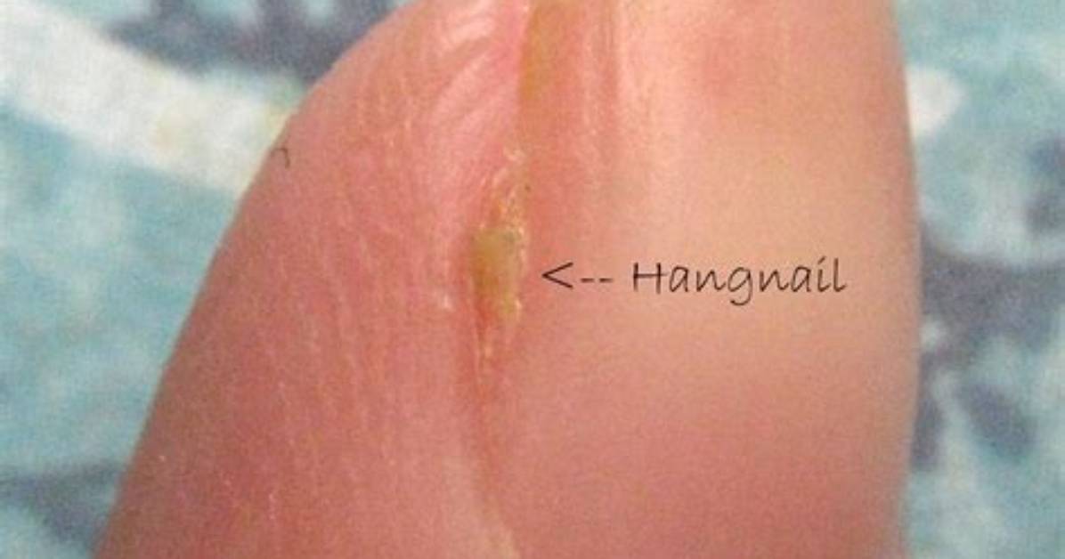 Should You Pull out Hangnails?