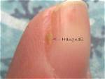 Should You Pull out Hangnails?