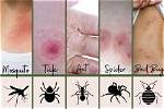 Should You Scratch Bug Bites?