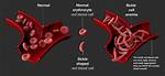 Sickle Cell Definition