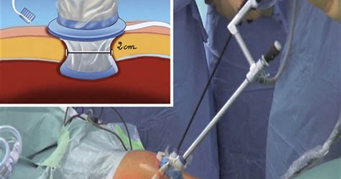Sigmoidectomy