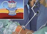 Sigmoidectomy