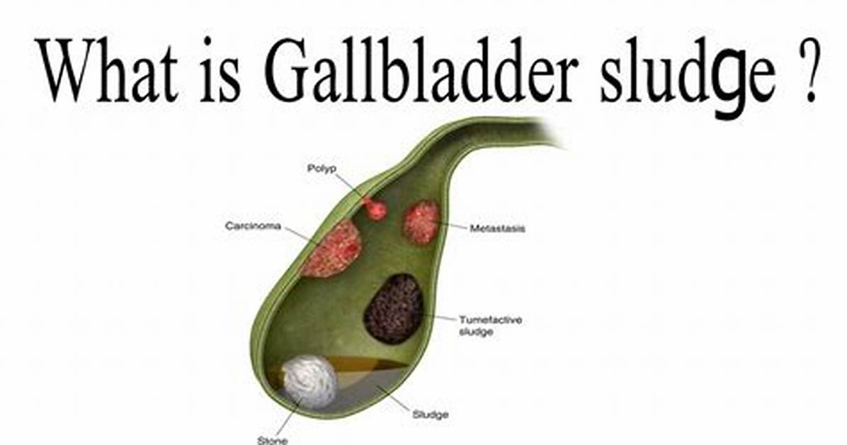 Sludge in Gallbladder
