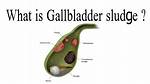 Sludge in Gallbladder