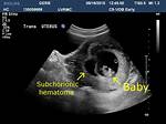 Small Subchorionic Hemorrhage