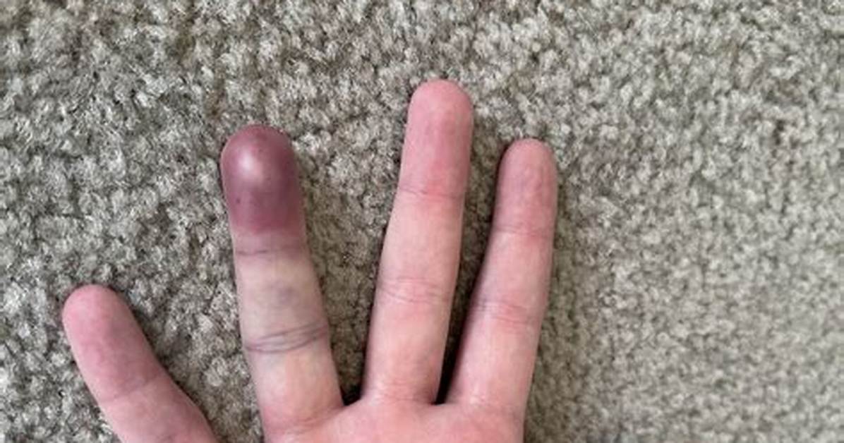 Smashed Finger