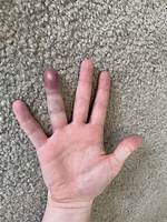 Smashed Finger
