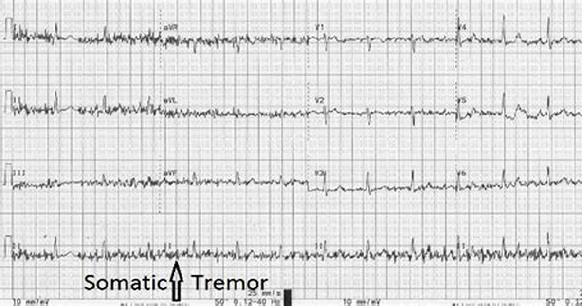 Somatic Tremor