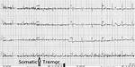 Somatic Tremor
