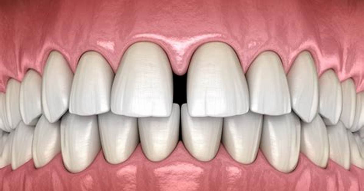Spaces Between Teeth
