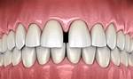 Spaces Between Teeth
