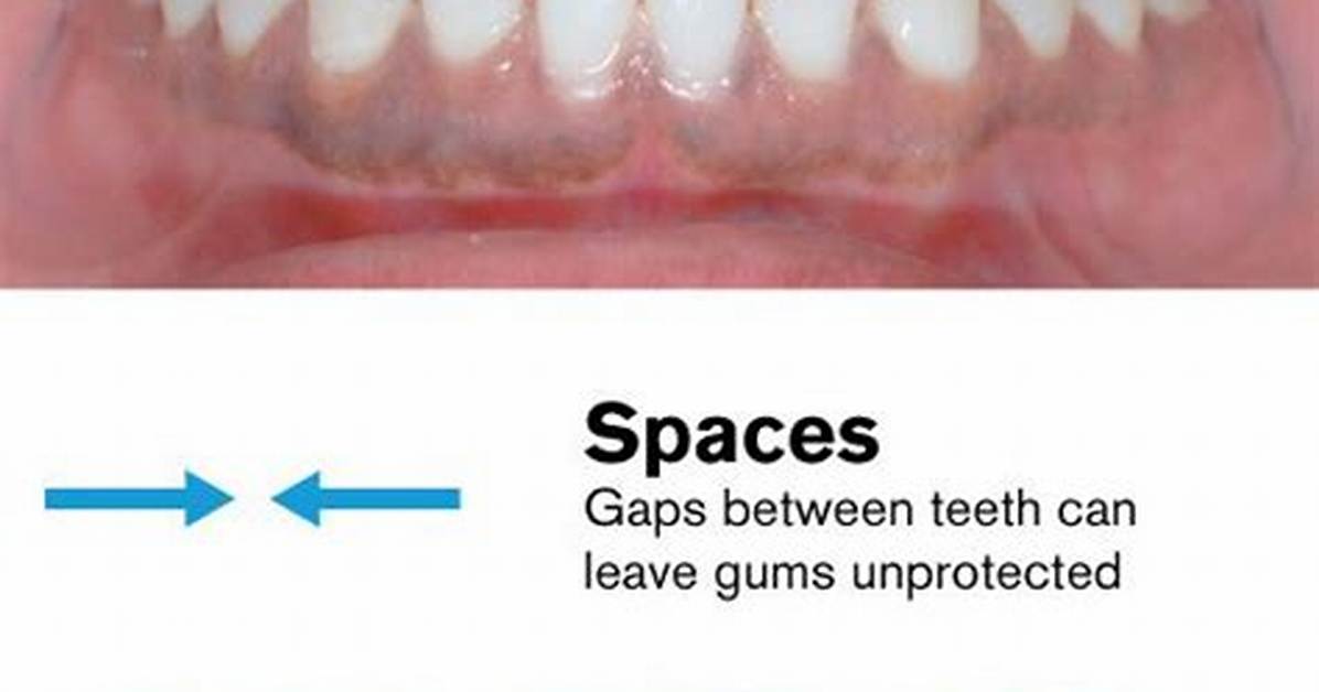 Spaces Where Teeth Are Missing
