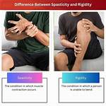 Spasticity vs Rigidity