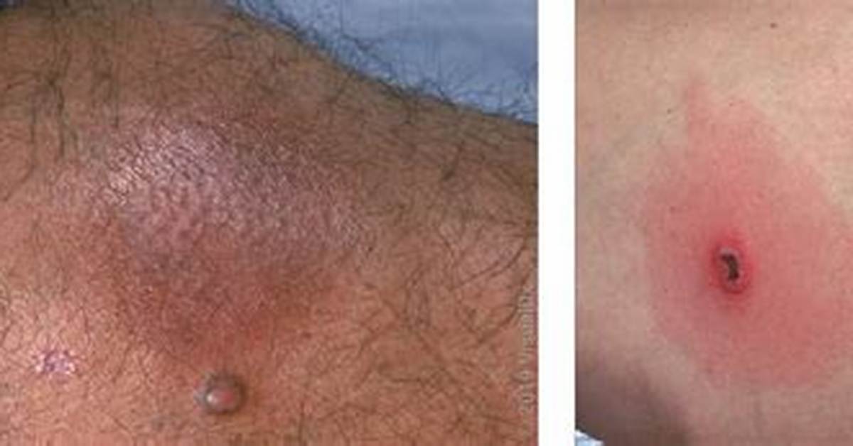 Spider Bite Red Circle