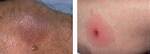 Spider Bite Red Circle