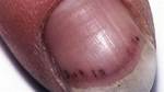 Splinter Hemorrhage Causes