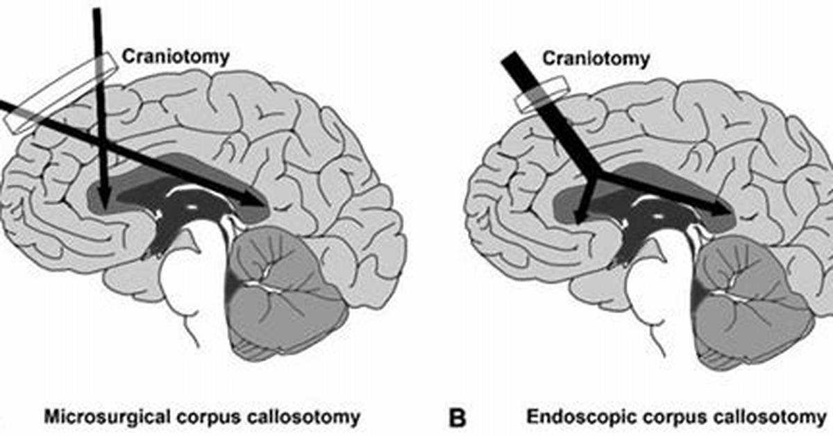Split Brain Surgery