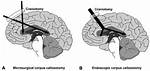 Split Brain Surgery