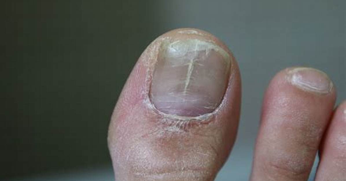 Split Toenail
