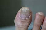 Split Toenail