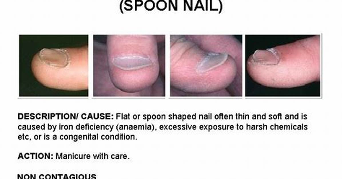 Spoon Nails Cause