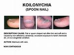Spoon Nails Cause