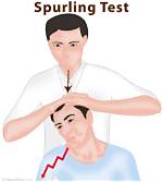 Spurling’s Test