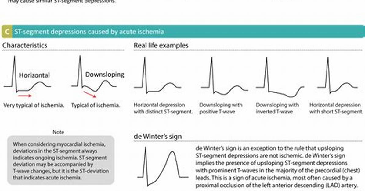 St Depression Causes