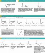 St Depression Causes
