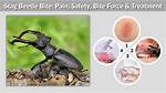 Stag Beetle Bite