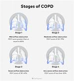 Stage 3 Copd