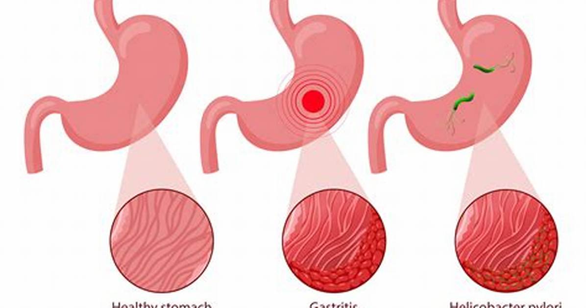Stomach Malady