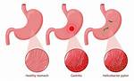 Stomach Malady